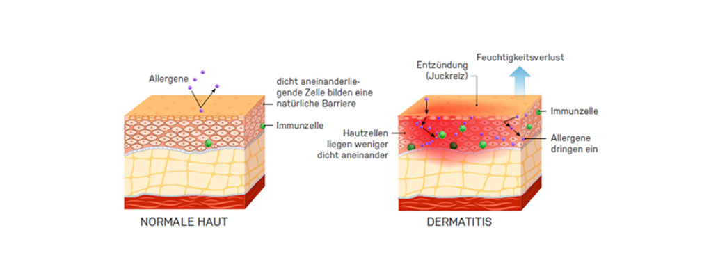 Der Aufbau der Haut - normale Haut und bei Dermatitis