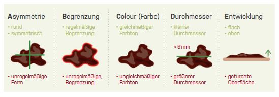 Früherkennung von Hautkrebs mit der ABCDE Regel
